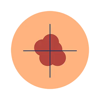 Melanoma abcde's irregular shape example