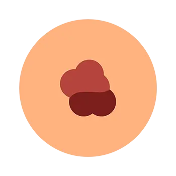 Melanoma abcde's color example