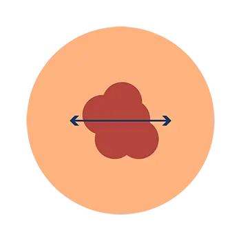 Melanoma abcde's diameter example